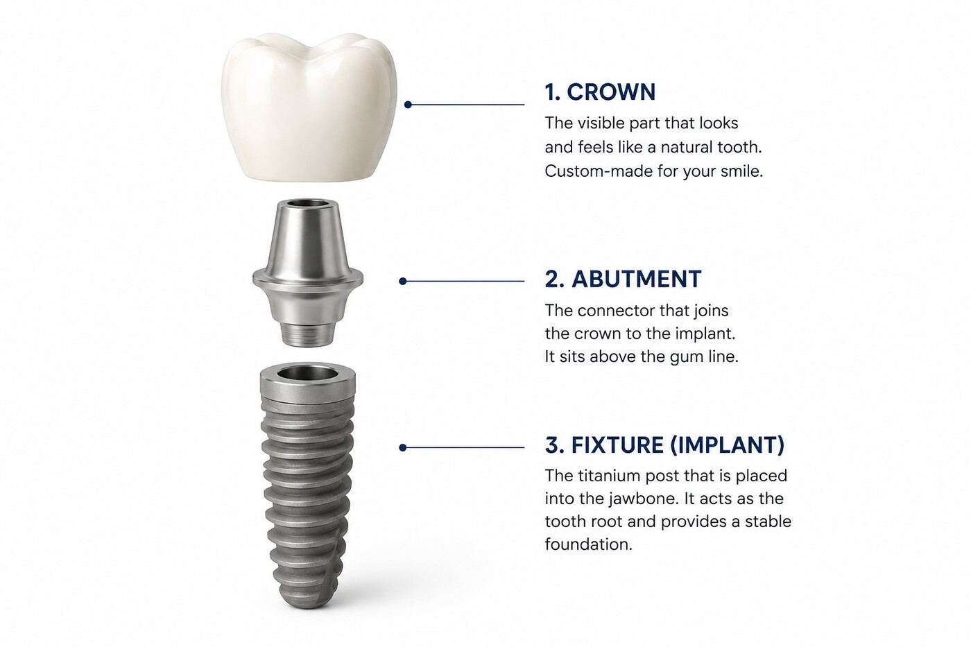 Diagram of a dental implant: crown, abutment and titanium fixture